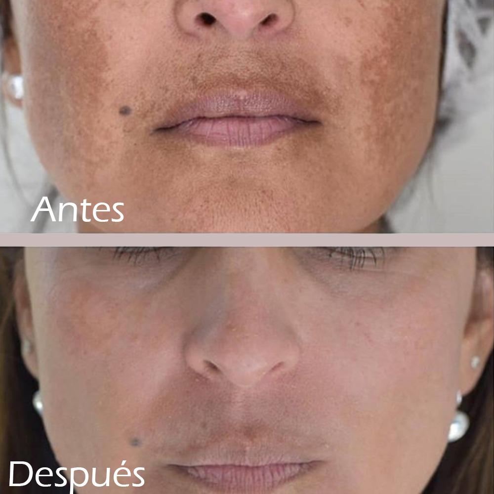 Resultado tratamiento manchas
